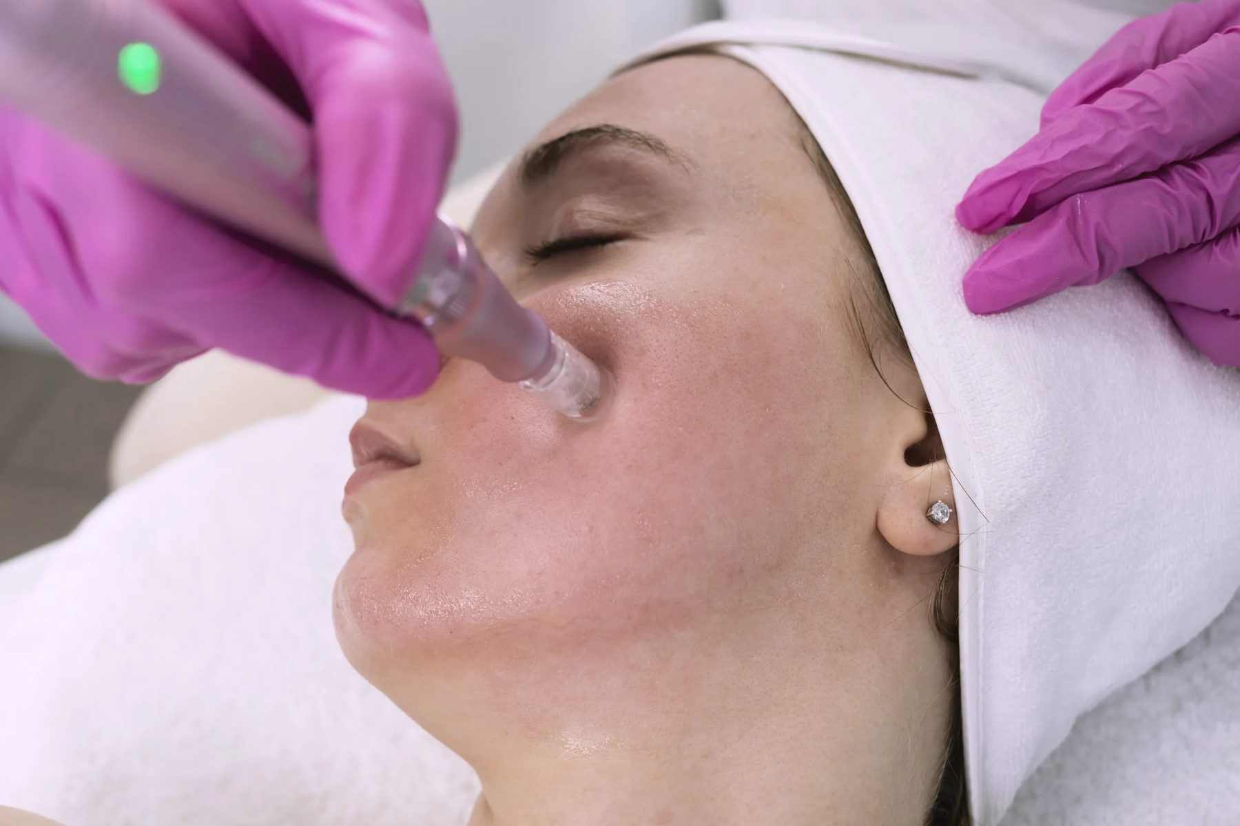 A gloved provider treating a client’s cheek with a handpiece